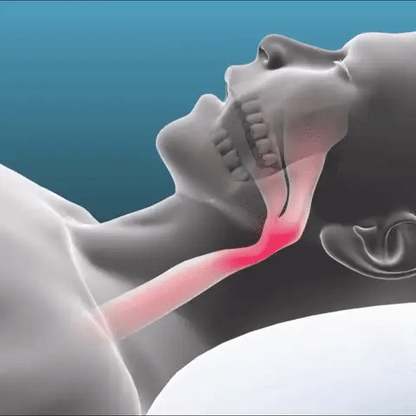 Anti Snoring Mouthpiece